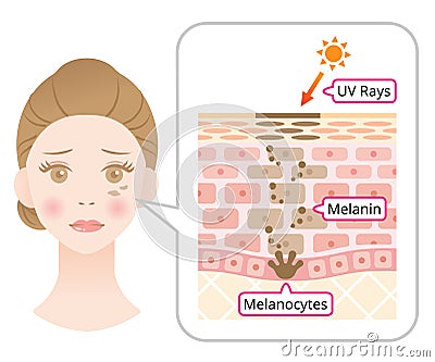 Skin mechanism of melanin and facial dark spots. Infographic illustration of woman face and skin layer. Beauty skin care concept Vector Illustration